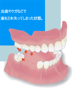 虫歯やケガなどで歯を２本失ってしまった状態