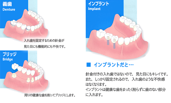 インプラントだと針金付きの入れ歯ではないので。見た目にも綺麗です。また、しっかり固定されるので、入れ歯のような不快感はなくなります。インプラントは健康な歯をまったく削らずに歯のない部分に入れます。