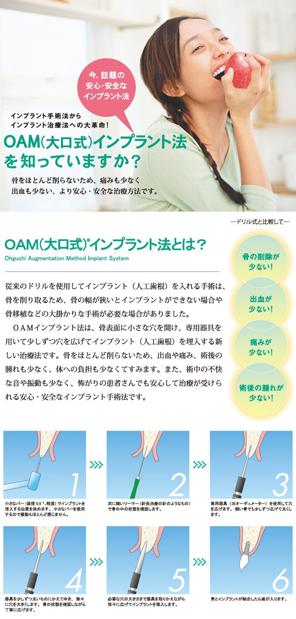 OAM(大口式)インプラント法
