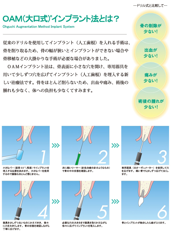 OAM(大口式)インプラント法