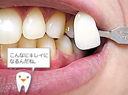 ホワイトニング後 こんなに綺麗になるんだね。